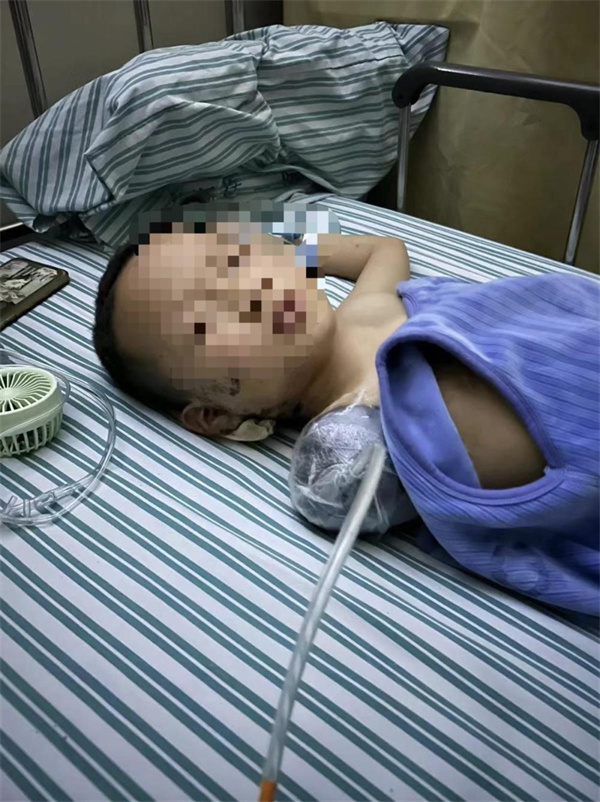 7岁的男童被邻居扔偏炮仗中致右臂受伤截止