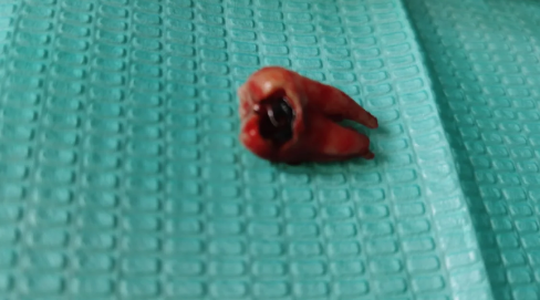 拔牙血凝块要保护几天3