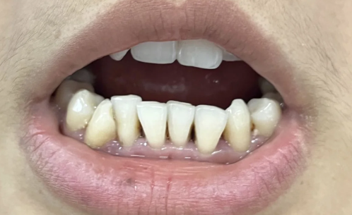 一个牙医的良心忠告种植牙3