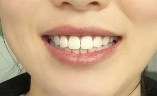 一个牙医的良心忠告种植牙2