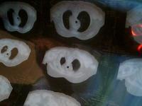 食道癌境像 食道癌境像