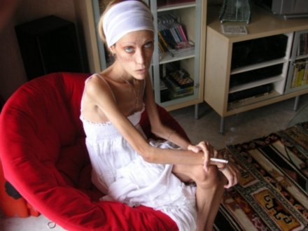 厌食症患者 厌食症患者